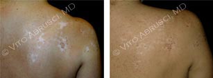 vitiligo5.jpg