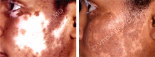vitiligo6.jpg